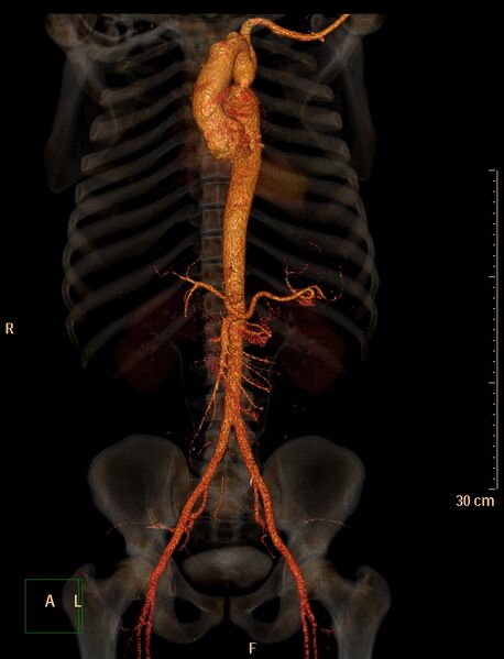 File:Coarctation of the aorta (Radiopaedia 49784-55050 3D VRT 2).jpg