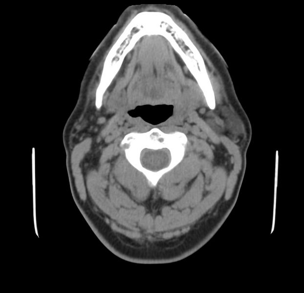 File:Colloid cyst of thyroid (Radiopaedia 22897-22923 Axial non-contrast 19).jpg