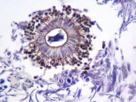 Aspergillus niger causing eumycetoma