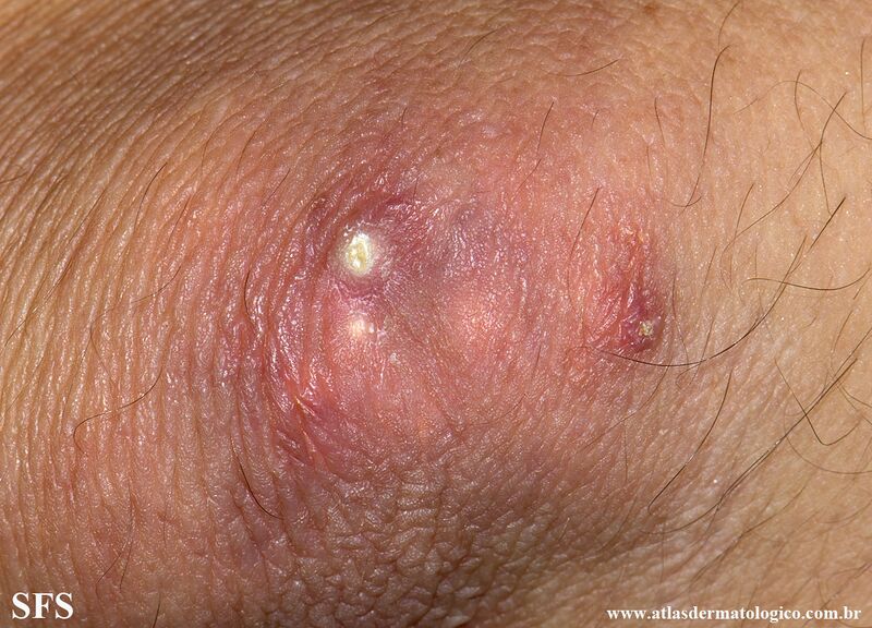 File:Gout (Dermatology Atlas 13).jpg