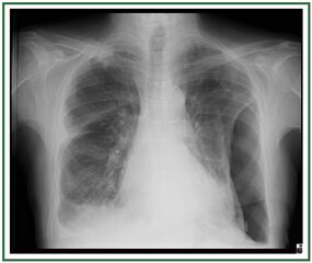 CXR of an individual affected by fibrothorax (consequence of tuberculosis)