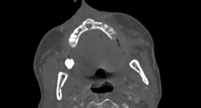 File:Maxillary heart (Rorschach radiology) (Radiopaedia 73911).jpg