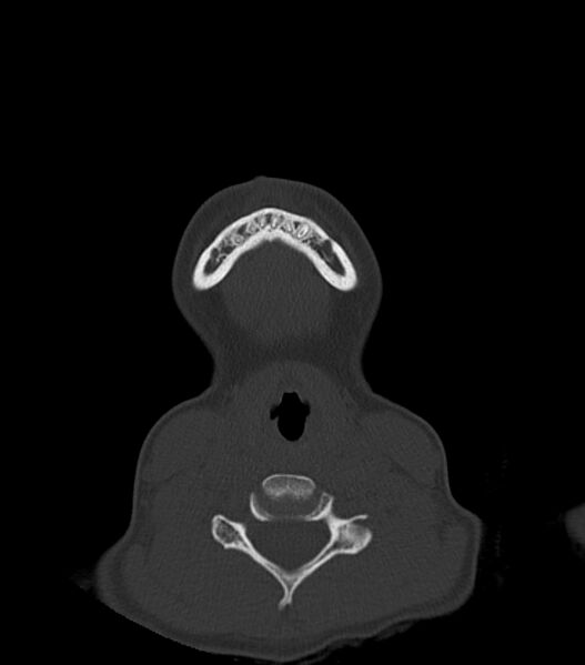 File:Nasoorbitoethmoid fracture (Radiopaedia 90044-107205 Axial bone window 16).jpg