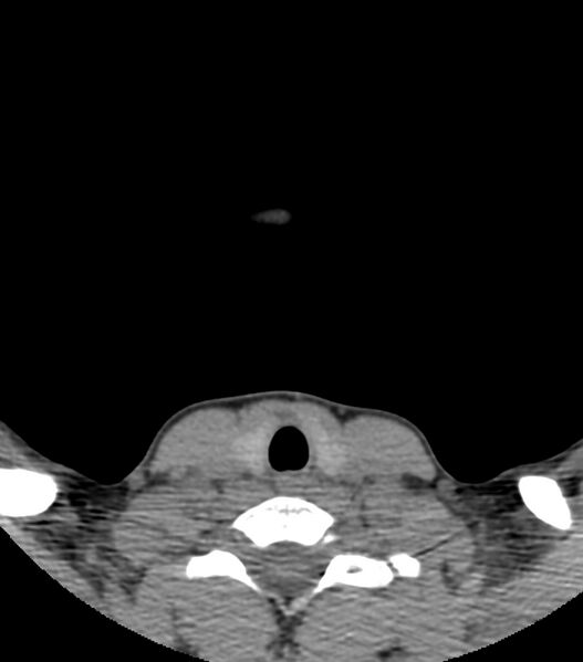 File:Nasoorbitoethmoid fracture (Radiopaedia 90044-107205 Axial non-contrast 1).jpg