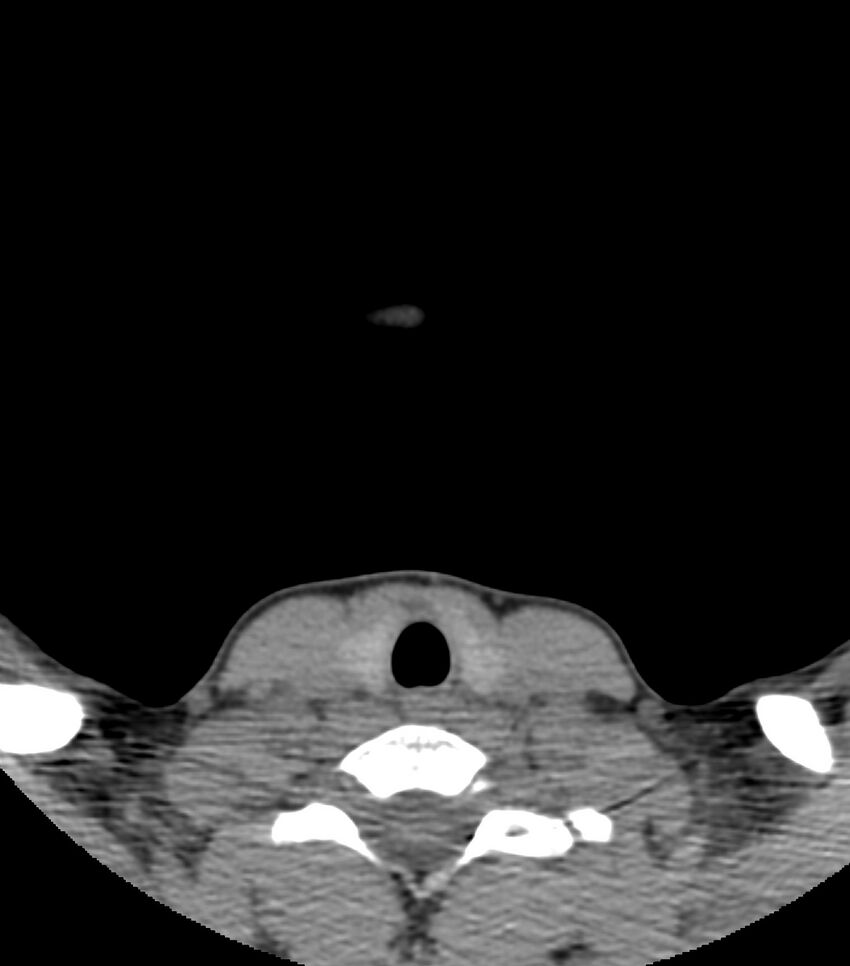 Nasoorbitoethmoid fracture (Radiopaedia 90044-107205 Axial non-contrast 1).jpg
