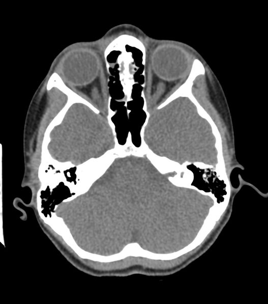 File:Nasoorbitoethmoid fracture (Radiopaedia 90044-107205 Axial non-contrast 162).jpg