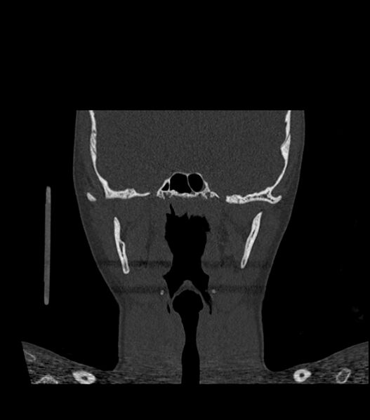 File:Nasoorbitoethmoid fracture (Radiopaedia 90044-107205 Coronal bone window 83).jpg