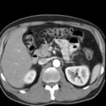 Necrotizing pancreatitis with acute necrotic collection (Radiopaedia 14470-14417 B 13).jpg