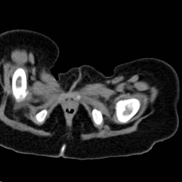 File:Neuroblastoma with skull metastases (Radiopaedia 30326-30960 Axial non-contrast 65).jpg