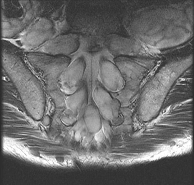 File:Neurofibromatosis type 1 (Radiopaedia 11671-12034 Coronal 1).jpg