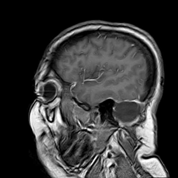 File:Neurofibromatosis type 2 (Radiopaedia 67470-76871 Sagittal T1 C+ 15).jpg