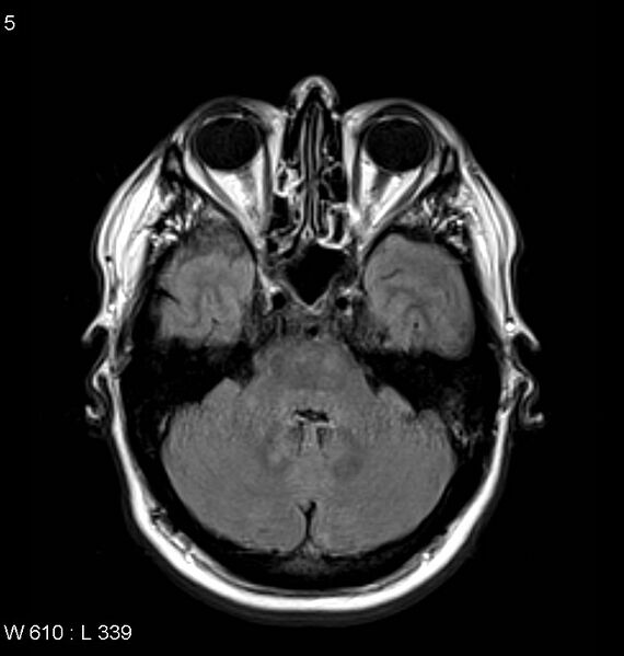 File:Neurosarcoidosis (Radiopaedia 10930-11351 Axial FLAIR 5).jpg