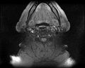 Non-Hodgkin lymphoma - parotid gland (Radiopaedia 71531-81890 T1 fat sat 7).jpg
