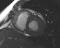 Non-compaction of the left ventricle (Radiopaedia 69436-79314 Short axis cine 126).jpg