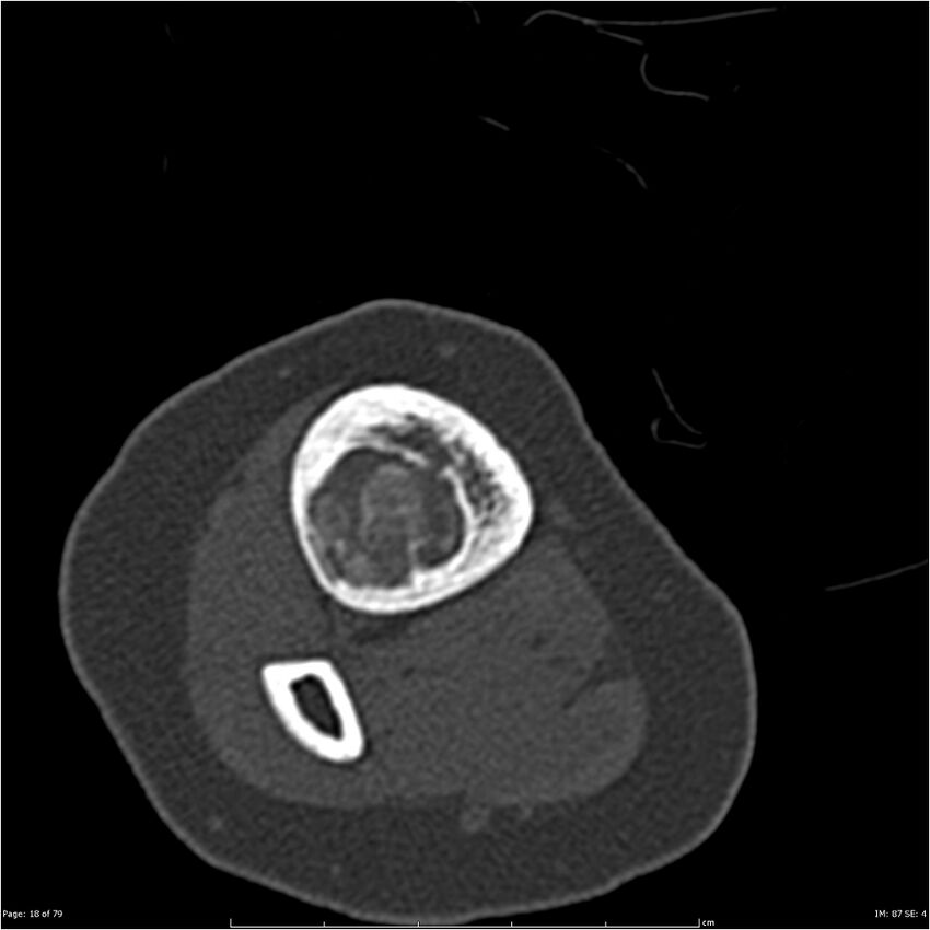 Non-ossifying fibroma (Radiopaedia 23651-23780 bone window 18).jpg