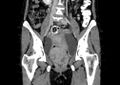 Non-puerperal uterine inversion (Radiopaedia 78343-91094 B 2).jpg