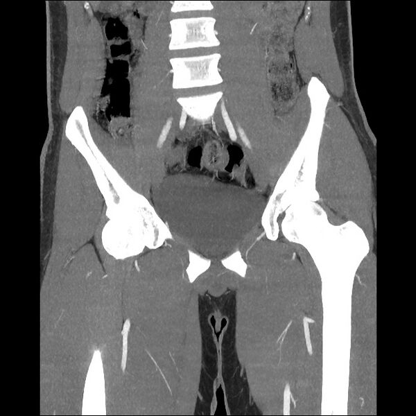 File:Normal CT angiogram of pelvis (Radiopaedia 45390-49430 B 23).jpg