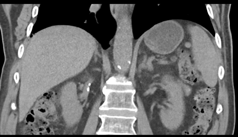 File:Normal CT intravenous cholangiogram (Radiopaedia 38199-40208 Coronal IVC 34).png