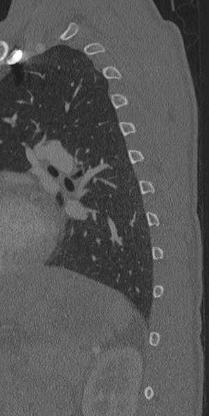 File:Normal CT thoracic spine (Radiopaedia 40181-42688 Sagittal bone window 5).png