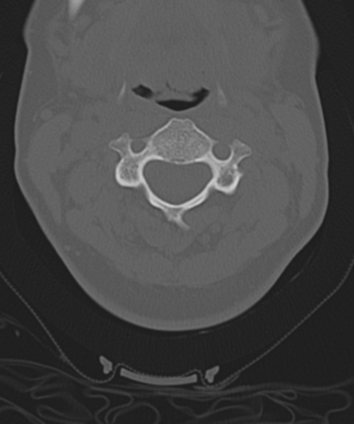 File:Normal cervical spine MRI (including Dixon) (Radiopaedia 42762-45926 Axial bone window 23).png