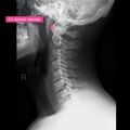 Normal cervical spine radiographs (Radiopaedia 32505-96697 A 3).jpeg