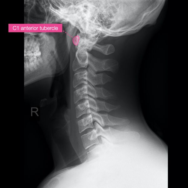 File:Normal cervical spine radiographs (Radiopaedia 32505-96697 A 3).jpeg