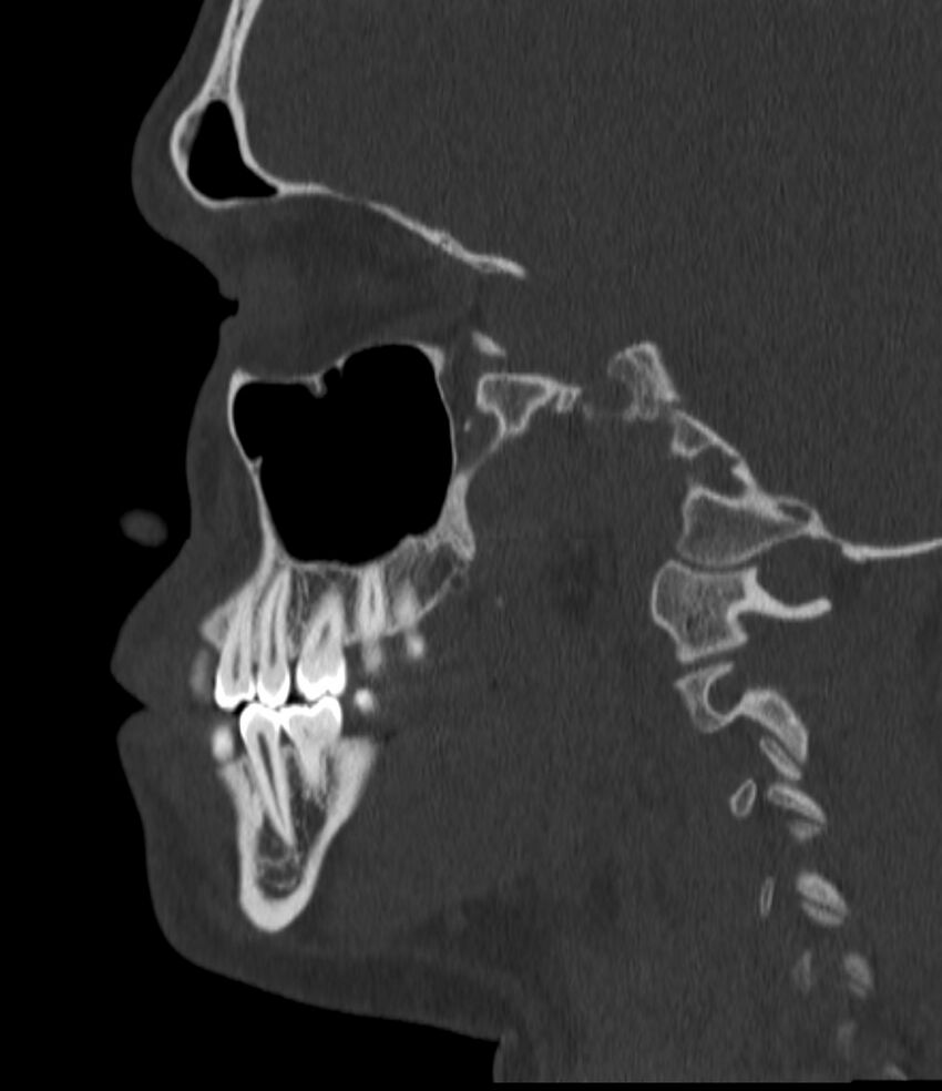 Normal facial bone CT (Radiopaedia 88742-105476 Sagittal bone window 67).jpg