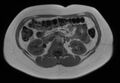 Normal liver MRI with Gadolinium (Radiopaedia 58913-66163 Axial T1 in-phase 11).jpg