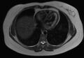 Normal liver MRI with Gadolinium (Radiopaedia 58913-66163 Axial T2 31).jpg