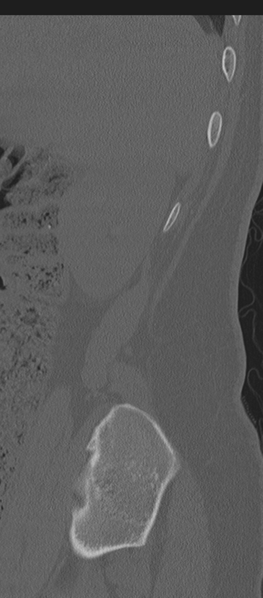 File:Normal lumbosacral CT (Radiopaedia 37923-39867 Sagittal bone window 93).png