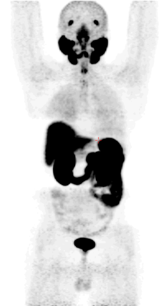 File:Normal physiological distribution (Ga-68 PSMA PET scan) (Radiopaedia 68145).PNG