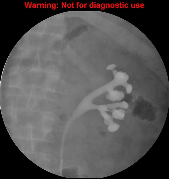 File:Normal retrograde pyelography of a native and transplant kidney (Radiopaedia 40480-43054 Native kidney 7).jpg