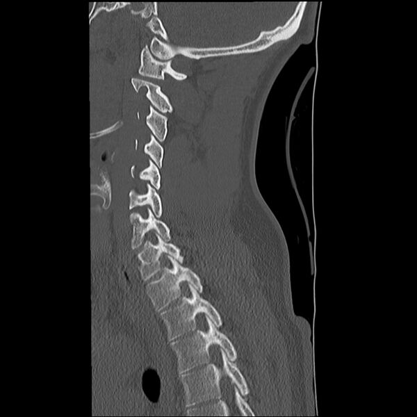 File:Normal trauma spine imaging (Radiopaedia 31753-32686 Sagittal bone window 28).jpg