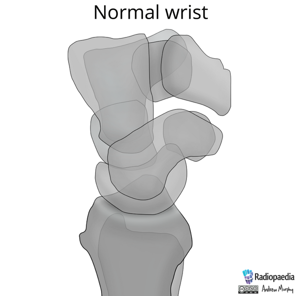 File:Normal wrist alignment, dorsal and volar intercalated segmental instability (illustration) (Radiopaedia 80949-94486 A 12).png