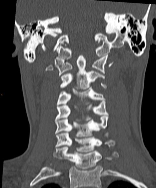 File:Occipital condyle fracture (Radiopaedia 61165-69056 Coronal bone window 7).jpg