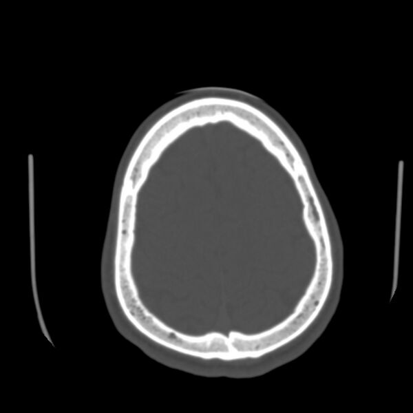 File:Occipital spur - asymptomatic (Radiopaedia 87753-104201 Axial bone window 176).jpg