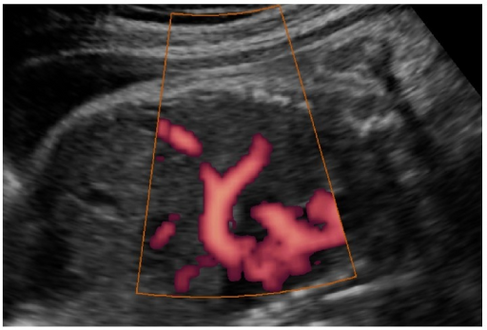 Ultrasound finding in a fetus showing liver herniation into the thorax