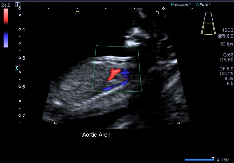 File:1st trimester nuchal-morphology ultrasound (Radiopaedia 44706-48477 General anatomy and NT 27).jpg