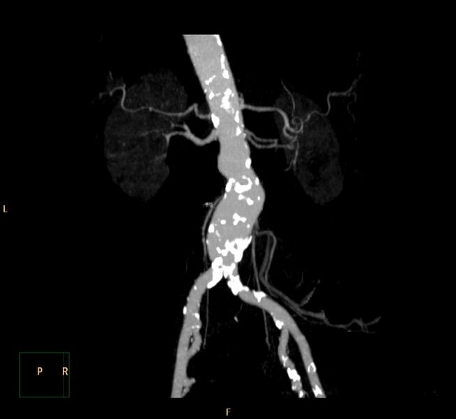 File:Abdominal aortic aneurysm (Radiopaedia 23703-23856 MIP 13).jpg