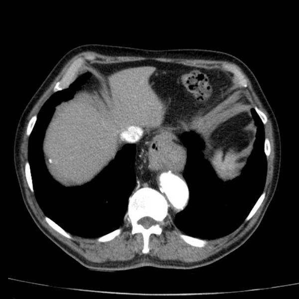 File:Abdominal aortic aneurysm (Radiopaedia 29248-29660 Axial C+ arterial phase 9).jpg