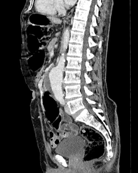 File:Abdominal aortic aneurysm (Radiopaedia 83581-98689 Sagittal C+ portal venous phase 52).jpg
