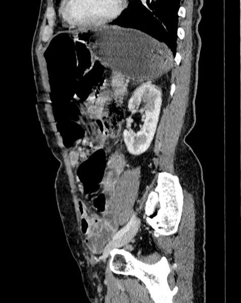 File:Abdominal aortic aneurysm (Radiopaedia 83581-98689 Sagittal C+ portal venous phase 91).jpg