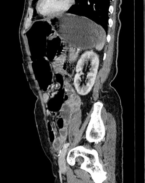 File:Abdominal aortic aneurysm (Radiopaedia 83581-98689 Sagittal C+ portal venous phase 97).jpg