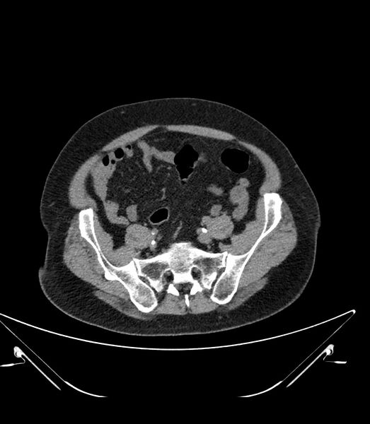 File:Abdominal aortic aneurysm with thrombus fissuration (Radiopaedia 46218-50618 Axial non-contrast 42).jpg