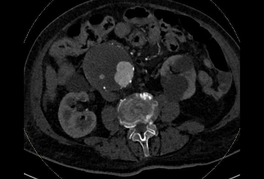 Abdominal aortic aneurysm with thrombus fissuration (Radiopaedia 73192-83919 Axial C+ arterial phase 105).jpg