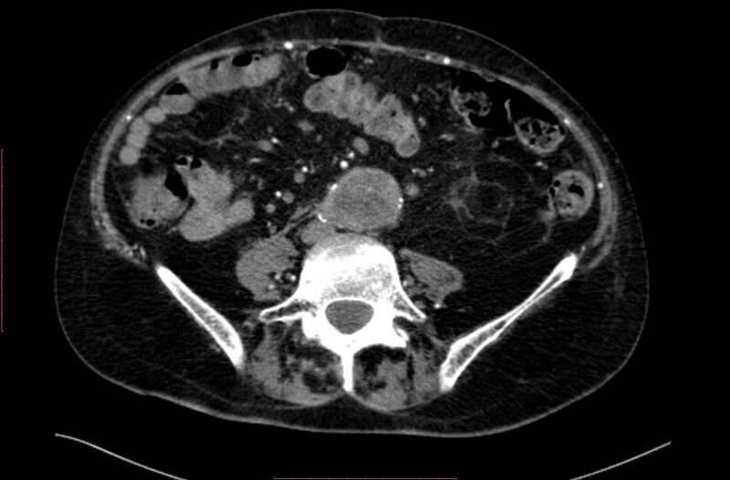 File:Abdominal aortic interposition tube graft and aneurysm thrombosis (Radiopaedia 71438-81857 Axial C+ arterial phase 120).jpg