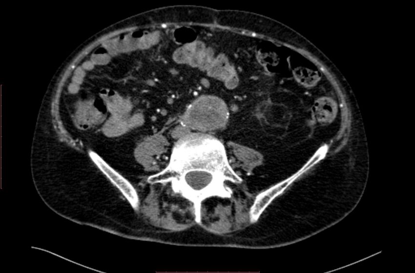 Abdominal aortic interposition tube graft and aneurysm thrombosis (Radiopaedia 71438-81857 Axial C+ arterial phase 120).jpg