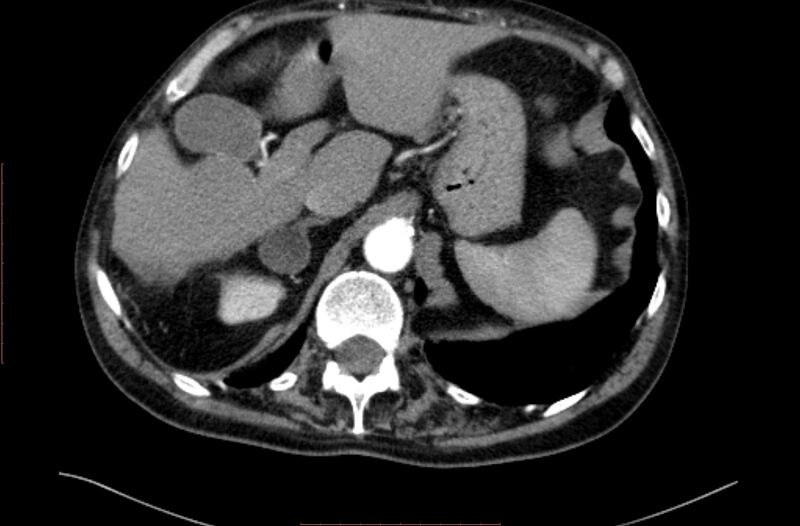 File:Abdominal aortic interposition tube graft and aneurysm thrombosis (Radiopaedia 71438-81857 Axial C+ arterial phase 7).jpg