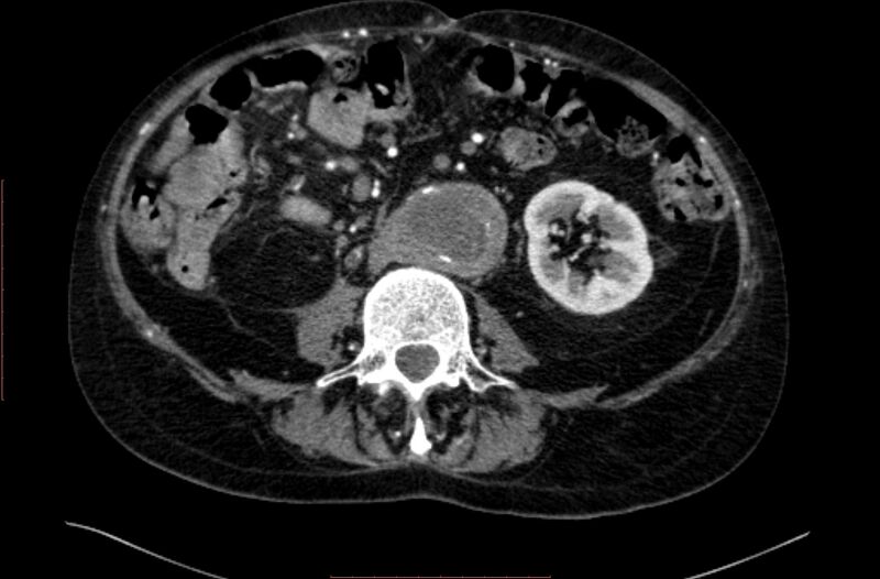 File:Abdominal aortic interposition tube graft and aneurysm thrombosis (Radiopaedia 71438-81857 Axial C+ arterial phase 93).jpg
