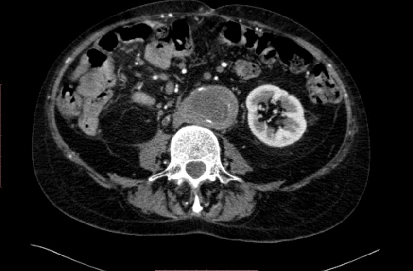Abdominal aortic interposition tube graft and aneurysm thrombosis (Radiopaedia 71438-81857 Axial C+ arterial phase 93).jpg